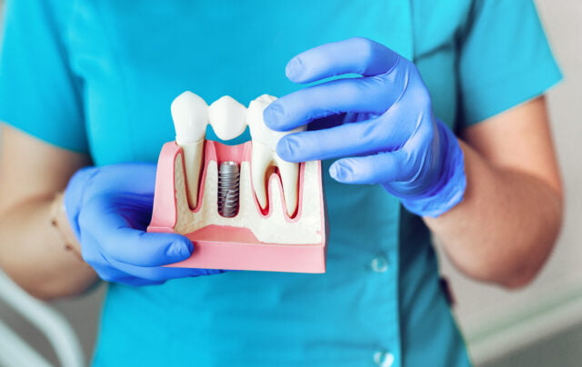 close up dental implant model hands dentist holding implant