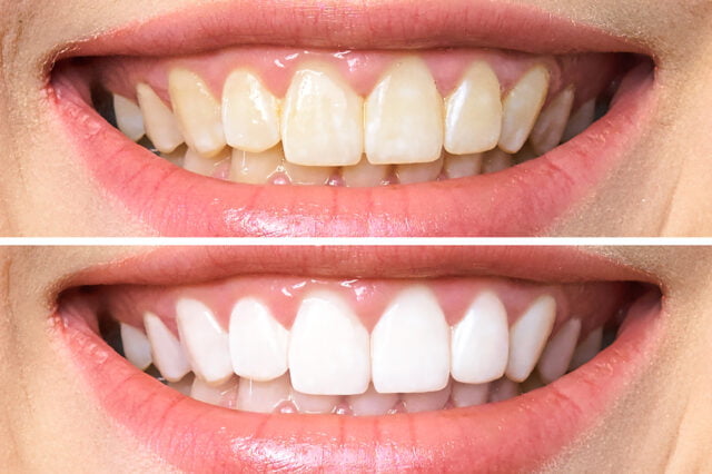 teeth before after whitening